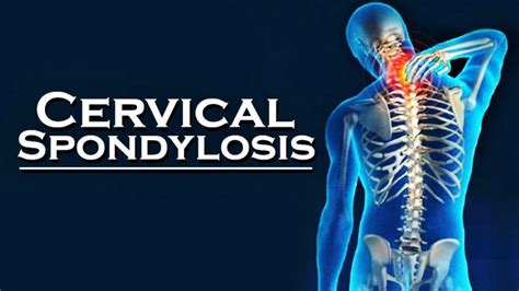 Cervical Spondylitis