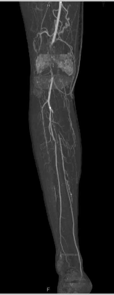 Vascular Occlusion Posterior Tibial Artery Adrenal Case Studies