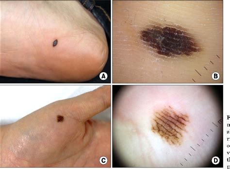 Stage 3 and 4 stage 3 melanoma has spread away from the primary tumor or into nearby lymph nodes. Figure 6 from Cutaneous Melanoma in Asians | Semantic Scholar