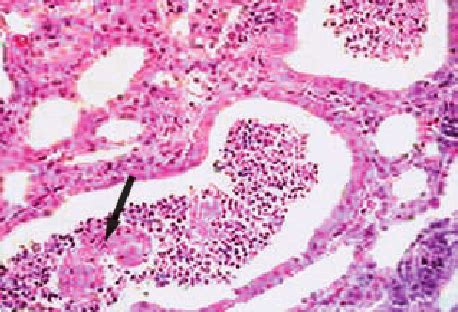 Secondary Renal Tubular Dilatation With Epithelial Damage Arrow And