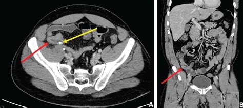 When Is Contrast Needed For Abdominal And Pelvic Ct Cleveland Clinic