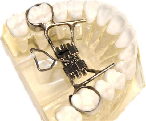What Is A Rapid Palatal Expander Ask An