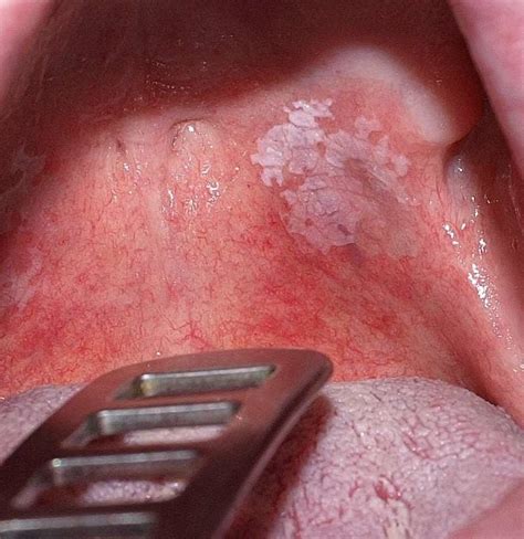 Leukoplakia Symptoms Causes And Prevention