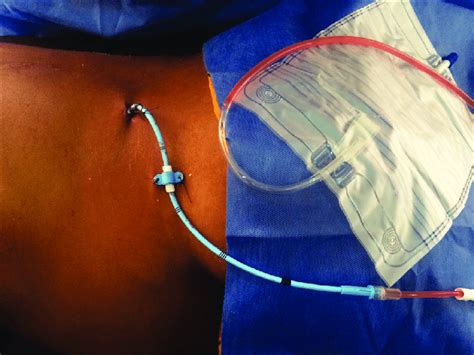 Shows Nephrostomy Tube Secured In Place With Sutures And Connected To