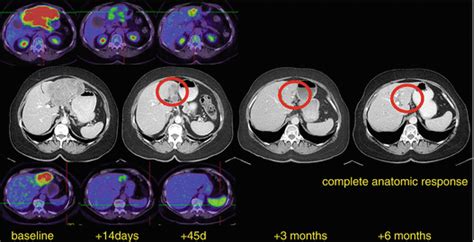 Role Of Petct In Melanoma Radiology Key