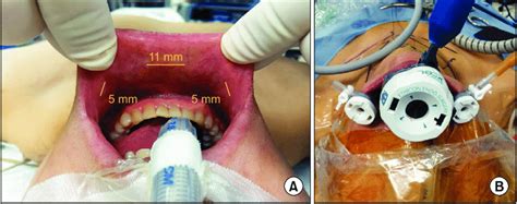 Incision And Trocar Placement In The Transoral Endoscopic Thyroidectomy