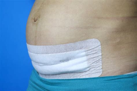 cesarean section bandage postpartum rehabilitation stock image image of ball body 199281769