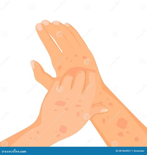 Rash Skin On Hand Rashes Itching Hands Scratch Arm In Red Spot