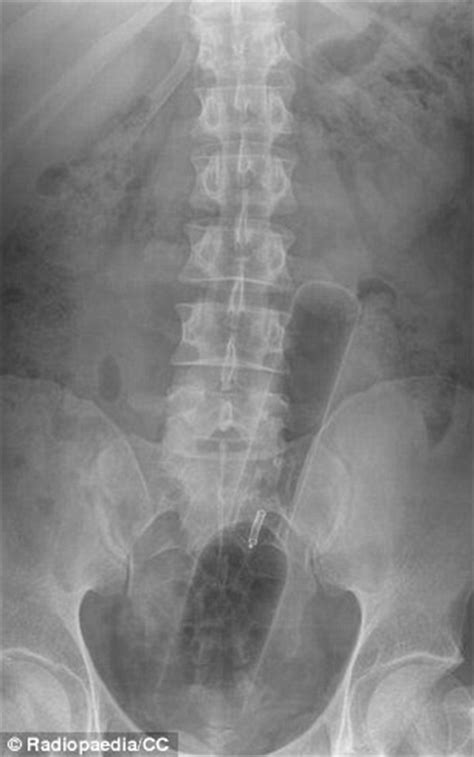 Doctors Share X Rays Of The Strangest Things They Ve Found Stuck In
