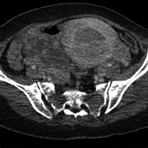 Contrastenhanced CT Scan Of The Whole Abdomen Showing Enhancing Masses