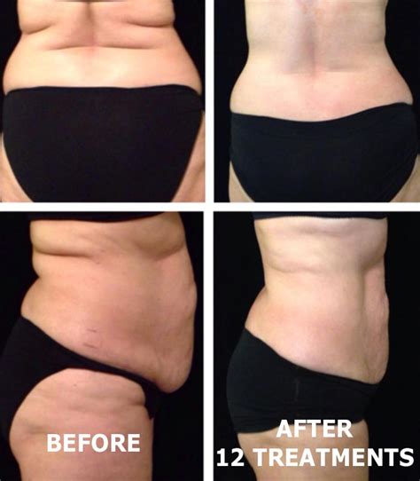 Post Op Fibrosis And Contouring Contour Body Lab