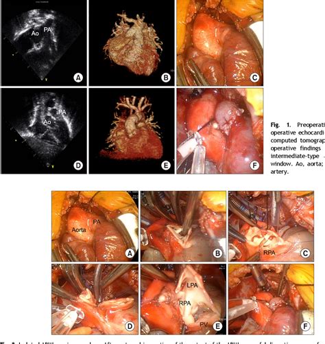 Figure 1 From Aortic Reconstruction Using A Main Pulmonary Artery Flap
