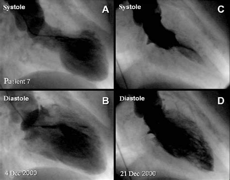 Figure From Tako Tsubo Transient Left Ventricular Apical Ballooning