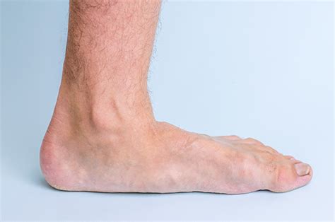 Dont Ignore Flat Feet Martin Foot And Ankle