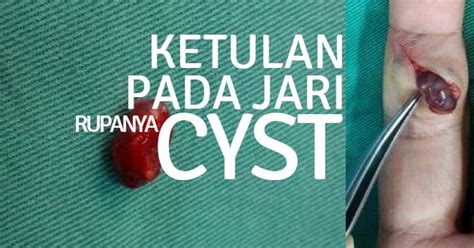 Namun, darah yang beku jika tidak pada tempatnya akan membuat seseorang terganggu kesehatannya, bahkan dapat mengkhawatirkan nyawa seseorang. Ada Benjolan Pada Jari, Rupa-rupanya CYST | sayaiday ...