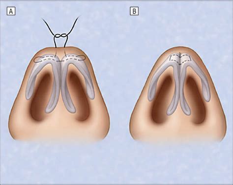 Reconstructive Rhinoplasty The 3 Dimensional Nasal Tip Archives Of