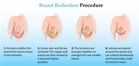 Finding a replacement flange is not as a straightforward process as one would expect. Breast Reduction: Are You a Candidate? Cost, Recovery, etc