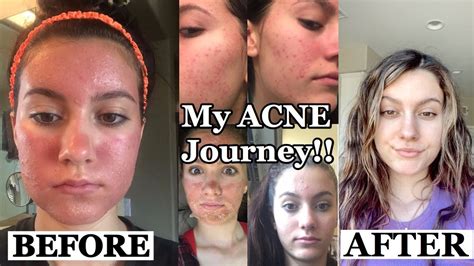 My Acne Story How I Cleared My Skin With Pictures Youtube