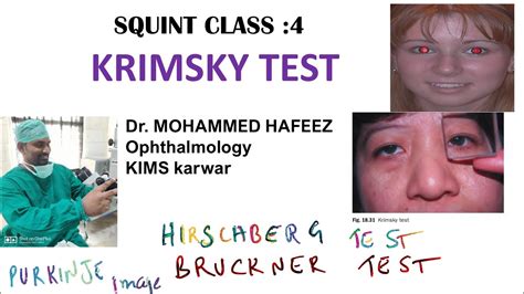 Krimsky Test Squint Class Hirschberg Test Bruckner Test