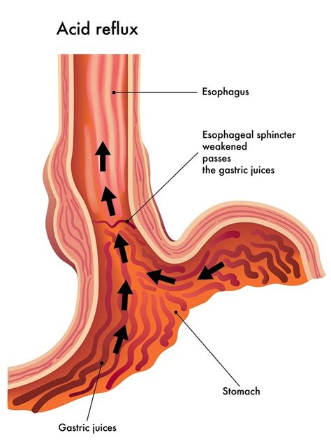 Acid reflux in dogs produces a pain similar to heartburn in humans, but a dog can't tell you when he is uncomfortable. 15 Natural Remedies for the Treatment of Acid Reflux and ...