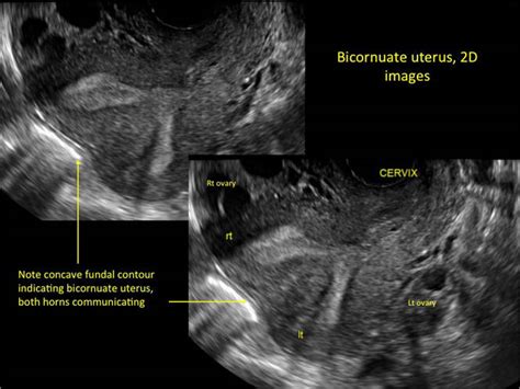 Congenital Uterine Anomalies A Resource Of Diagnostic Images Part 2