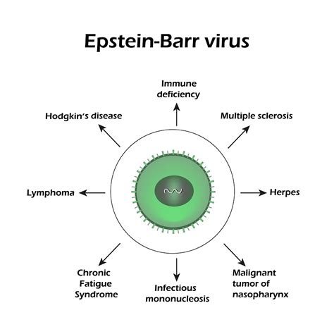 Epstein Barr Virus Complication Complications Of Epstein Barr Virus