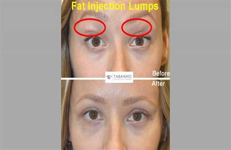 Eyelid And Facial Fat Injection Specialists Los Angeles Ca