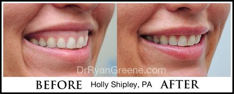 This solution is cheaper than surgery and less intrusive. Smile enhancement with Juvederm facial filler and ...
