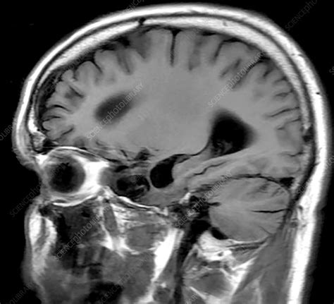 Chronic Post Traumatic Brain Injury Mri Stock Image C0306065