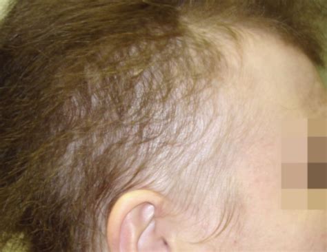 I was thinning all over as well, and had excellerated hair loss for about 3 months when i started finasteride, then it stabilized and with the months passing, it improved a bit. Alopecia Areata - Causes, Types, Symptoms & Treatment ...
