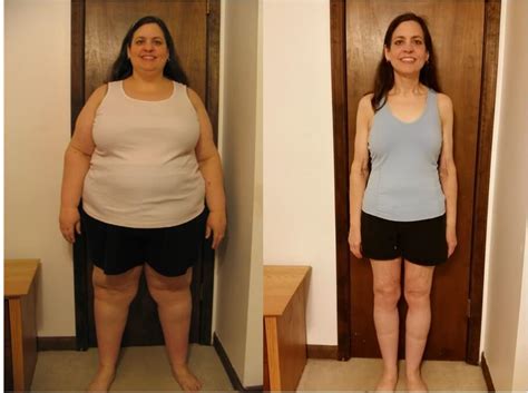 Gastric Sleeve Before And After Pictures And What You Can Expect Bariatric Surgery Source