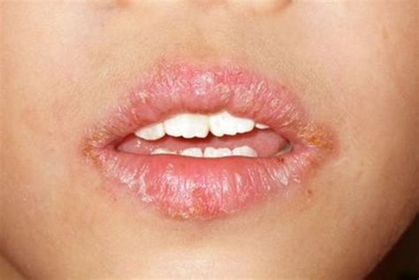 Angular Cheilitis Pictures Treatment Symptoms Causes Lip