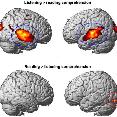 Brain Activation For The Contrast Between Reading And Listening