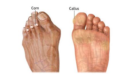 Corn And Callus Causes Presentation And Treatment Bone And Spine