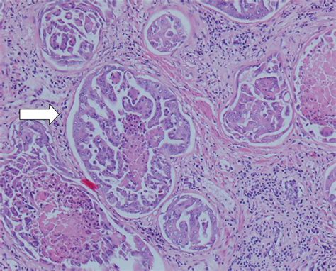 Early prostate cancer usually causes no symptoms or signs. Canine Prostate Carcinoma: Four Clinical Cases in Sexually ...