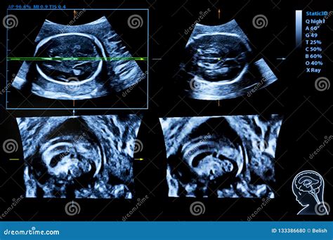 Colourful Image Of Pregnancy Ultrasound Monitor Stock Photo Image Of