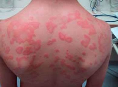 It causes severe gastrointestinal symptoms like. Basics - Food Allergy Education