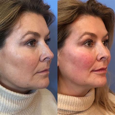 Treated Areas Cheeks Lips Nasolabial Folds Marionette Lines And
