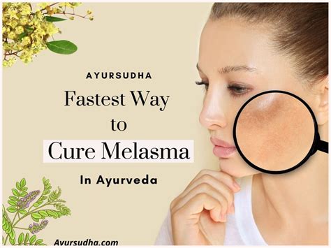 What Is The Fastest Way To Cure Melasma