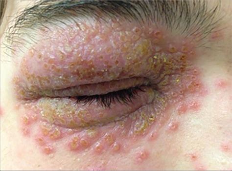 Eruption Of Eyelid Target Lesions Adolescent Medicine Jama