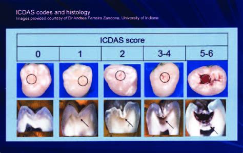 Icdas Caries Classification System For Dental