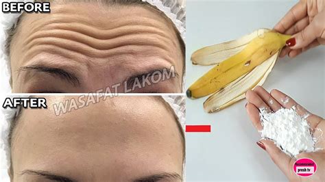Even If You Are 70 Apply It And Remove Forehead Wrinkles Naturally Quickly Youtube