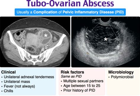 Em3am Pelvic Inflammatory Diseasetubo Ovarian Abscess Laptrinhx News