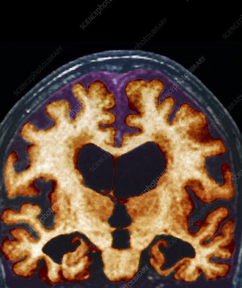 Alzheimers Disease Brain Mri Scan Stock Image C0041461 Science