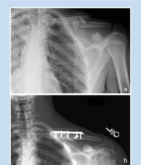 Middle Third Comminuted Diaphyseal Clavicle Fracture In A 16 Year Old