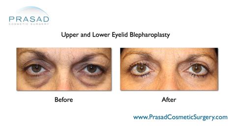 Eye Lift Before And After Photos Eyelid Surgery Dr Prasad