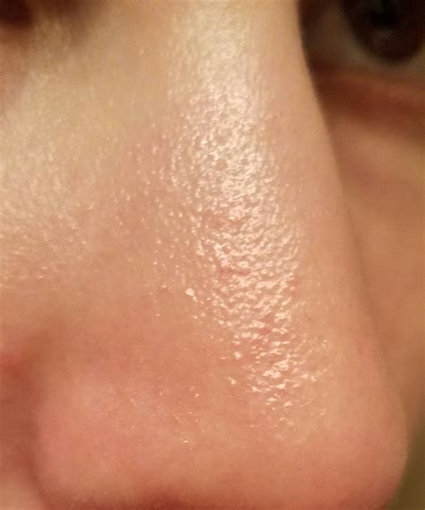 Textured Bumps On My Nose Appeared Yesterday General Acne Discussion By Safariprincess
