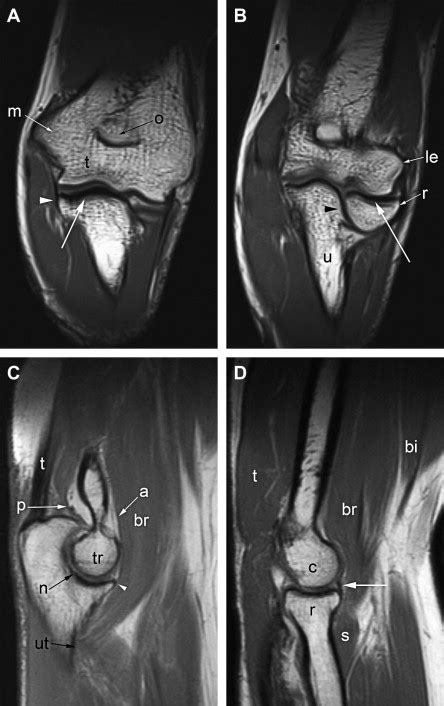 Normal And Variant Anatomy Of The Elbow On Magnetic Resonance Imaging