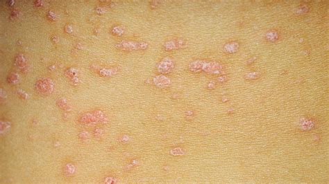 Types Of Psoriasis Causes Symptoms Treatment And Prevention