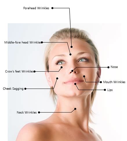 Thread Lift Before And After Uk An Instant Facelift Thread Lift Is The